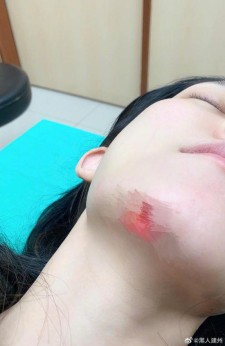 黑人晒范玮琪下巴手术照：以后还是开灯睡好